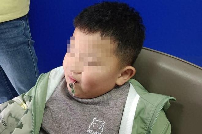 拉链卡牙缝7岁小孩哥淡定接受救援(图1)